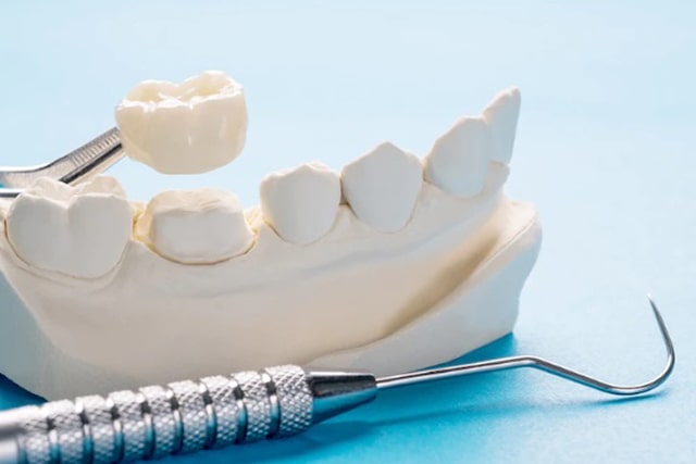 dental-crown-service